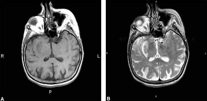 Figure 3. (A) Axial T1-weighted image