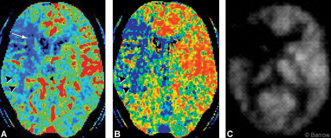 Figure 3. (A) Preoperative axial CT perfusion image