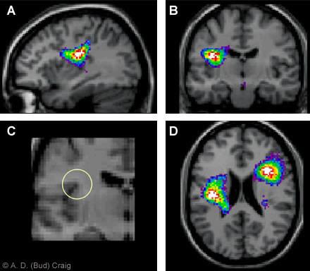 Figure 3. (A) Sagittal, (B) coronal, (C) close up of coronal view, and (D) axial PET scans