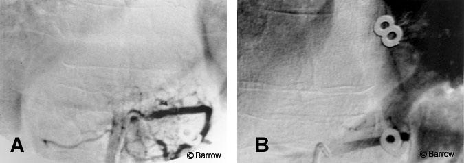 Figure 3. (A) Selective angiography of the left T12 pedicle shows an extensive vascular network