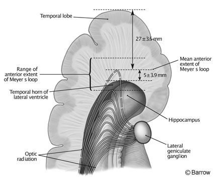 Figure 3. Axial illustration of the anterior temporal lobe