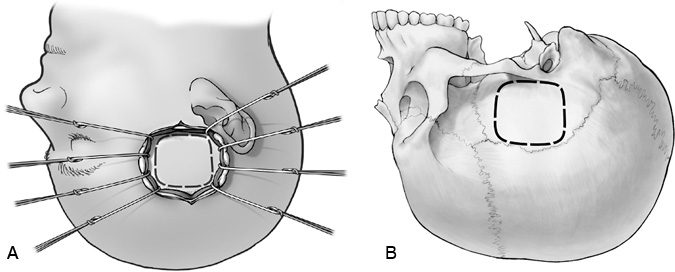 The Middle Fossa Approach - Barrow Neurological Institute The Middle Fossa Approach - Barrow Neurological Institute