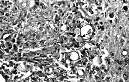 Figure 3. Fragments of crystalline foreign material (arrows) within the granuloma