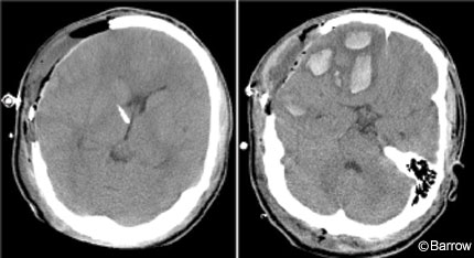 Figure 3. Immediate postoperative sequential axial computed tomographic scans