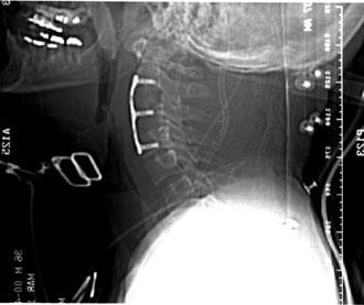 Figure 3. Lateral cervical spine radiograph demonstrating Synthes (Synthes Spine, Paoli, PA) plate in place.