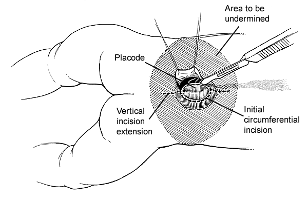 Figure 3. Operative field as viewed by the surgeon.