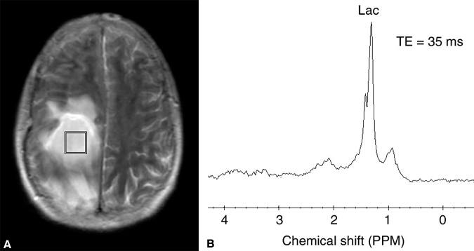 Figure 3. Proton magnetic resonance spectroscopy in a treated abscess.