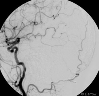 Figure 3. Right common carotid artery angiographic injection