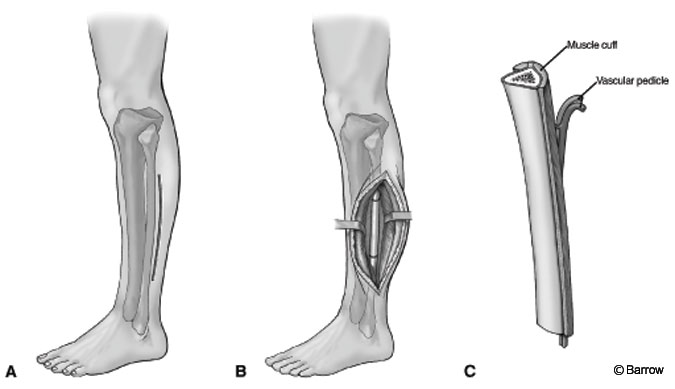 Figure 3. Vascularized fibular graft