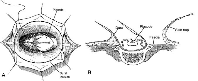 Figure 4. (A) Surgeon’s view of the neural placode during closure.