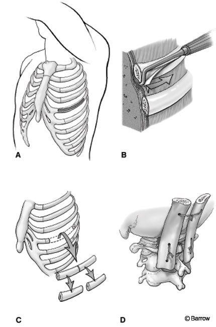 Figure 4. (A) The incision over the ribs exposes two ribs along a curved segment