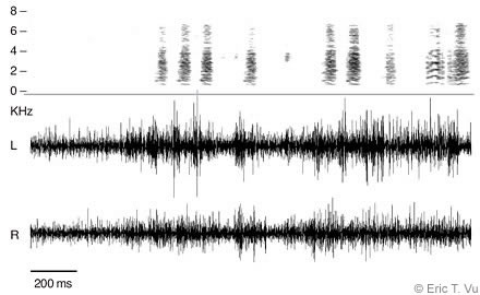 Figure 4. A neural correlate of the singing impairment