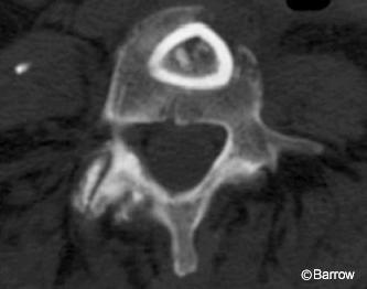 Figure 4. Axial computed tomographic scan