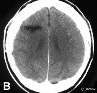 Figure 4. Contrast-enhanced computed tomographic scan of the brain
