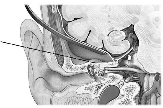 The Middle Fossa Approach - Barrow Neurological Institute The Middle Fossa Approach - Barrow Neurological Institute