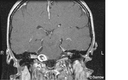 acoustic gamma knife neuroma fifteen treatment months figure after stereotactic neuromas radiosurgery management enhanced necrosis seen central