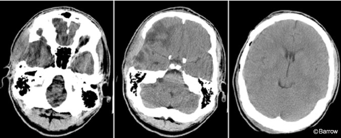 Figure 4. Sequential axial computed tomographic scans