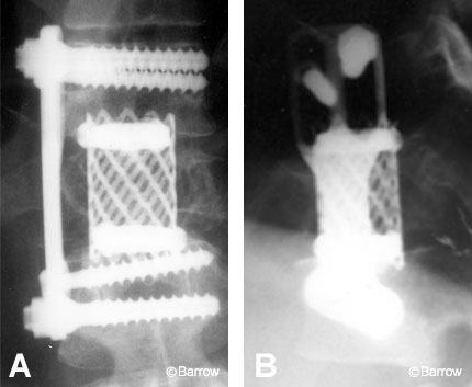 Figure 5. (A) Anteroposterior and (B) lateral plain radiographs