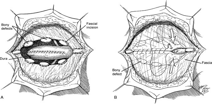 Figure 5. (A) Dural closure and fascial incision