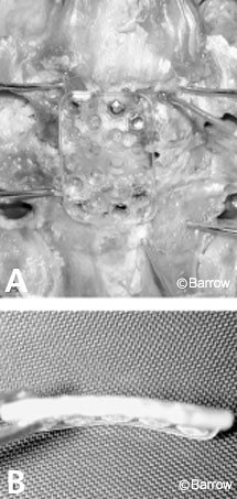 Figure 5. (A) Single-level plate in place on a cadaveric specimen
