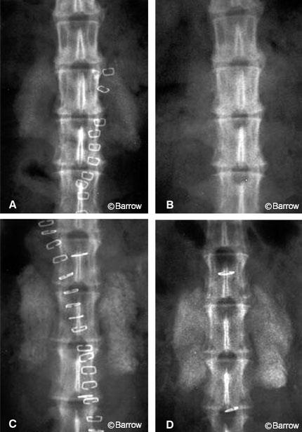 Figure 5. Serial anteroposterior radiographs