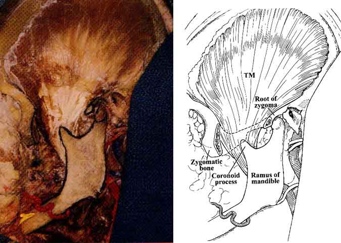 The Infratemporal Fossa: An Anatomic Review | Barrow