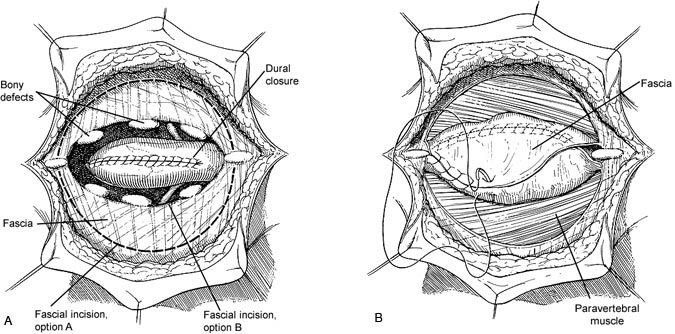 Figure 6. (A) Alternate fascial closure using semilunar flaps