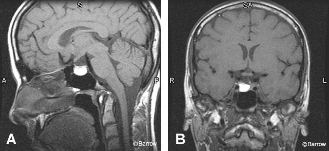 Figure 6. (A) Sagittal T1-weighted noncontrast images