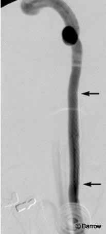 Figure 6. Five-month follow-up cerebral angiogram shows excellent patency of the stented segment (arrows) and no evidence of the pseudoaneurysm.