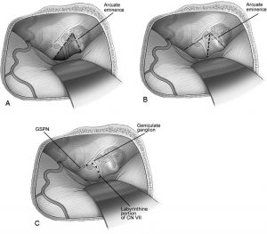 Figure 6. Options for exposing the internal auditory canal (IAC).