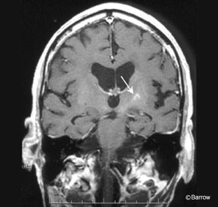 Figure 6. T1-weighted contrast-enhanced coronal magnetic resonance image