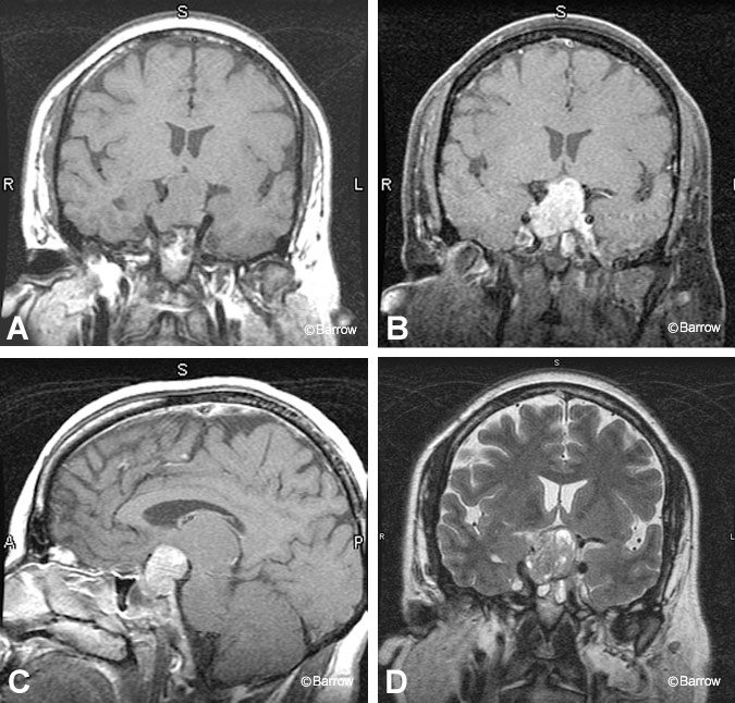 Figure 7. (A) Coronal T1-weighted precontrast image