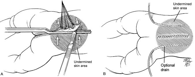 Figure 7. (A) The skin is approximated and trimmed.