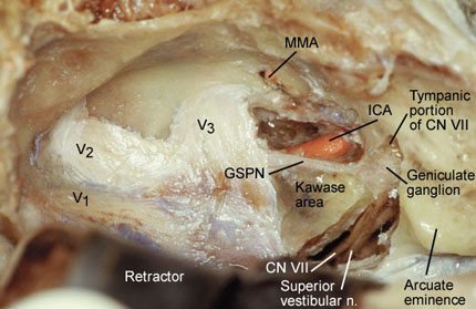 Figure 7. The transKawase approach requires exposing the internal auditory canal