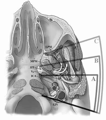 Infratemporal Fossa Branches of Mandibular Nerve (CN V3) Diagram