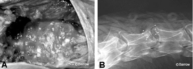 Figure 9. (A) Intraoperative picture of single-level plate at C3-C4 in a sheep.