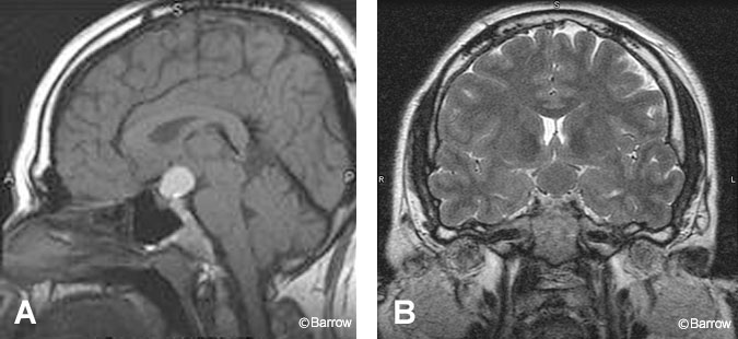 Figure 9. (A) Sagittal T1-weighted precontrast image reveals a hyperintense suprasellar cystic lesion consistent with an adamantinomatous craniopharyngioma. (B) Coronal T2-weighted image shows evidence of optic chiasm compression.