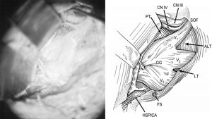 Figure 9. Cadaveric photograph (A) and illustration (B) showing the inferolateral view of the cavernous sinus region