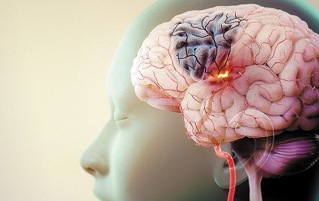 this illustration shows an ischemic stroke caused by a blood clot and the resulting loss of blood flow to part of the brain