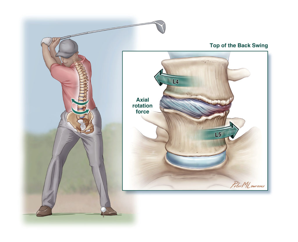 An illustration of how the modern golf swing stresses the lumbar spine