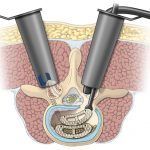Minimally invasive spine surgery illustration