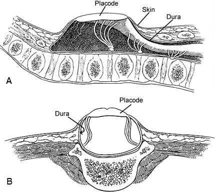 myelomeningocele repair barrow myelomeningocele repair