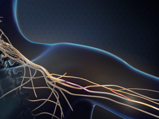 nerve transfer surgery results