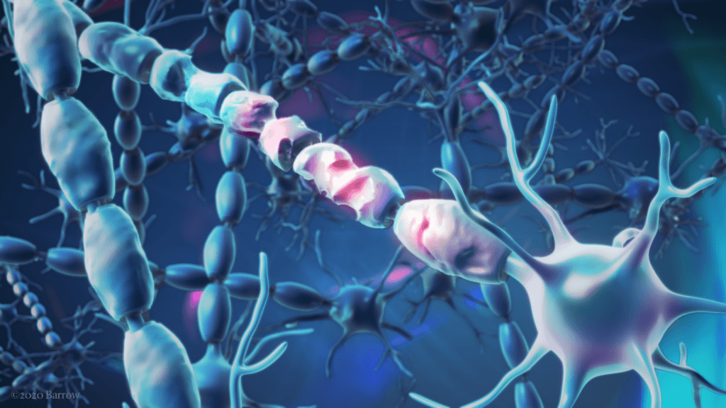 Illustration of demyelination of nerve fibers in multiple sclerosis
