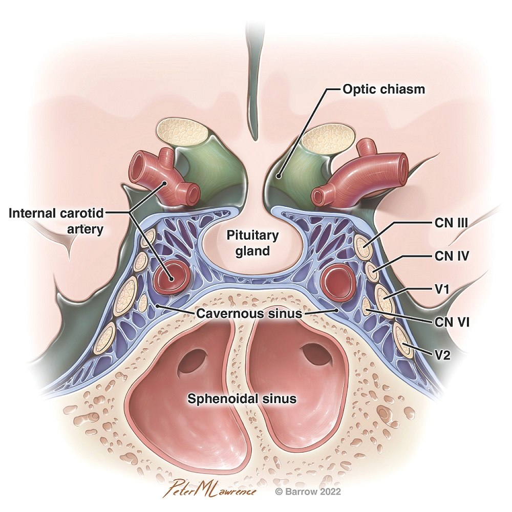 illustration showing the pituitary gland in relation to the internal carotid arteries, the optic chiasm, cranial nerves, the cavernous sinus, and the sphenoidal sinus