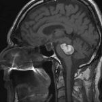 pontine caverernous malformation mri