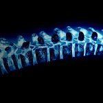 spinal xray