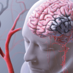 effects of a stroke illustration