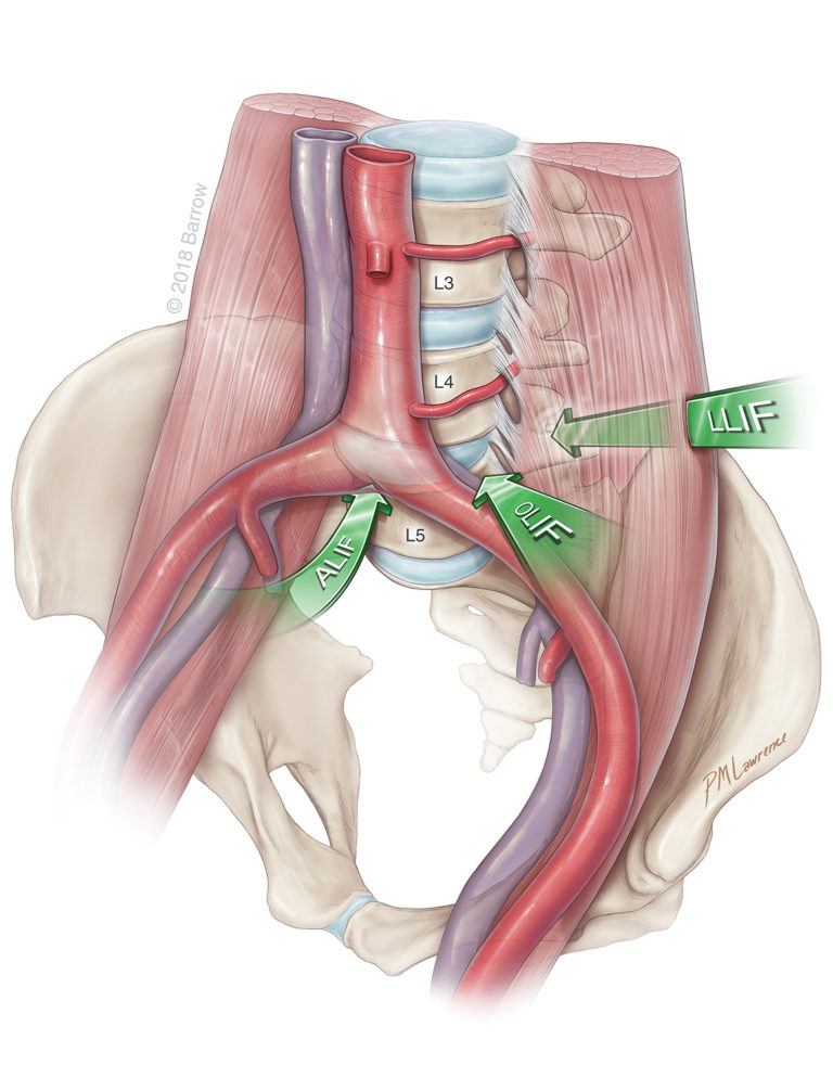 What is ALIF Surgery? | Barrow Neurological Institute