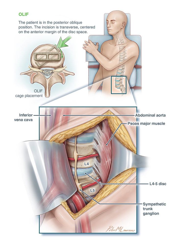 diagram showing cage placement, patient positioning, and the surgical approach for olif spine surgery